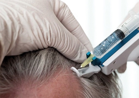 مزوتراپی مو چیست؟ آیا این روش از ریزش مو جلوگیری می کند؟