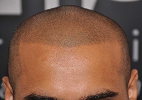 آیا ممکن است بعد از کاشت مو، موهای کاشته شده دچار ریزش شوند؟