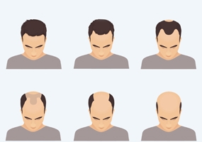 ریزش مو با الگوی طاسی مردانه چیست و راه‌های تشخیص آن کدامند؟